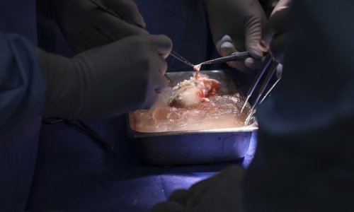 Transplantacija svinjskog GMO bubrega čovjeku