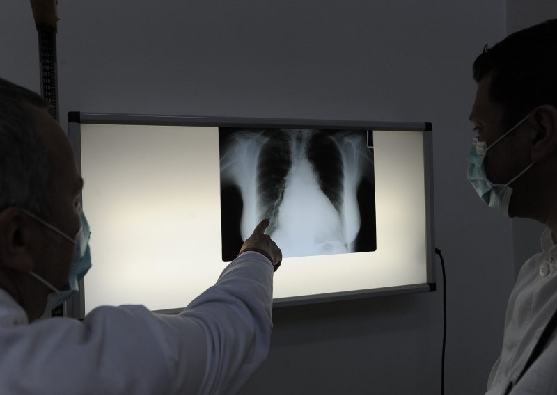 Svjetski dan kronične opstruktivne bolesti pluća: Trenutno je najveći uzrok pušenje, a uskoro će biti zagađenje