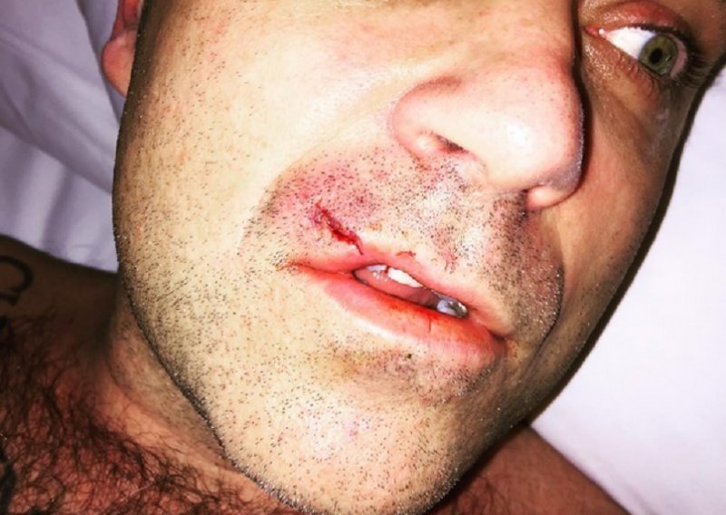 Robbie Williams pokazao posljedice bizarne nezgode