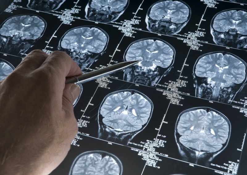 Test otkriva hoćete li dobiti Alzheimera