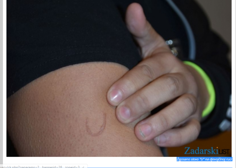 Zadarski učenik za vrijeme nastave učenici žigosao slovo 'U' na ruku