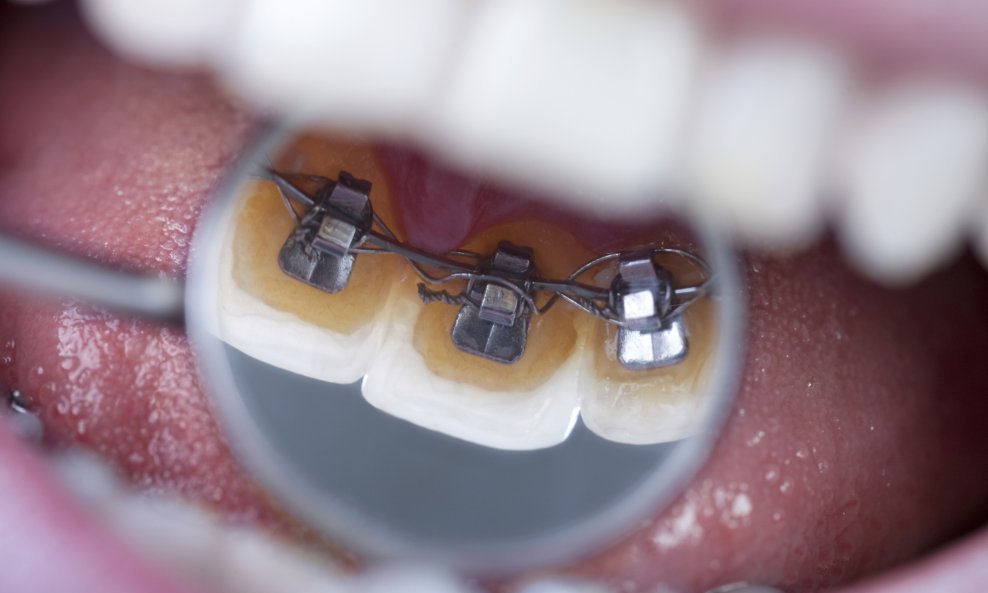 aparatić za zube ortodont