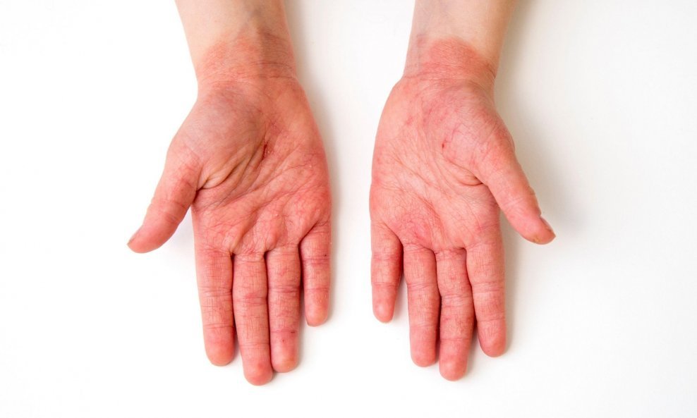 Neki dokazi sugeriraju da su kožna stanja možda češća kod dugotrajnih pacijenata