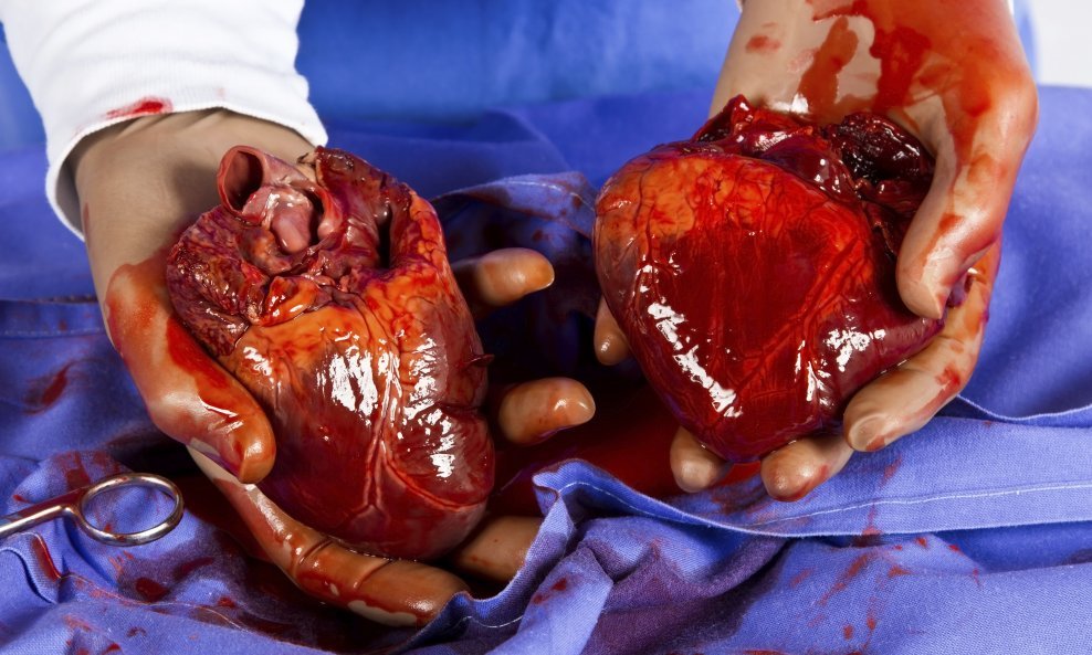 transplantacija srca