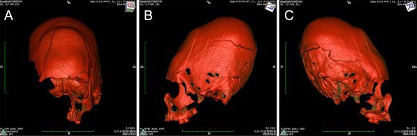 CT snimka izdužene lubanje