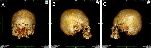CT snimka povišene lubanje