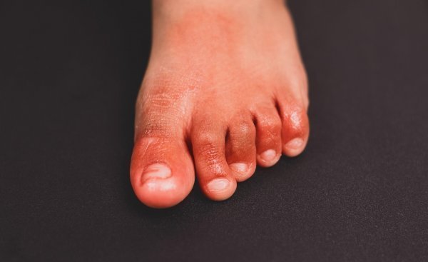 Natečeni nožni prsti jedan su od mogućih simptoma Covida-19