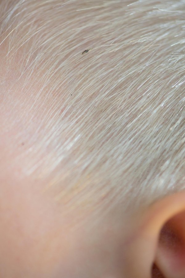 Ovako izgleda uš u kosi