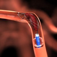 Stent