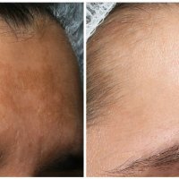 Prije i poslije koristenja White 3