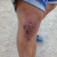 Ozljede koje su dokumentirali volonteri No Name Kitchen