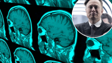 [VIDEO] Musk tvrdi da će moždani čip testirati na ljudima već za šest mjeseci, prvi će ga javno isprobati