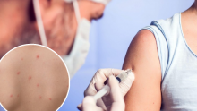 U Britaniji zbog epidemije ospica krenula kampanja za cijepljenje