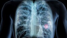 Svijet u šoku: Razvijena tableta koja prepolovljava rizik smrti od raka pluća
