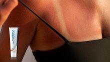 Opekline od sunca – što ako ih unatoč SPF-u zadobijete?