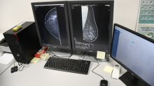 Uskoro mobilni mamograf u ruralnim dijelovima Splitsko-dalmatinske županije