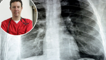 Kako prepoznati tzv. hodajuću upalu pluća i kada se javiti liječniku