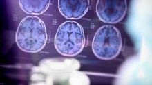 Neurolog o novom lijeku protiv Alzheimera: 'Treba ga učiniti što prije dostupnim'