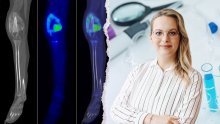Mlada hrvatska znanstvenica istražuje mikrosfere koje napadaju rak kostiju, a štede zdravo tkivo