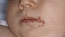Sve više slučajeva impetiga, no stručnjaci smiruju: Nema razloga za paniku