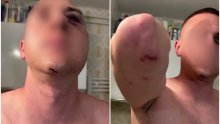 Pretučeni Slovenac u Medulinu: Nikome ne želim ovakve ozljede