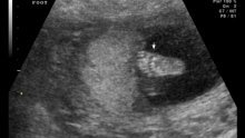 Majke će prije abortusa slušati kucanje srca fetusa