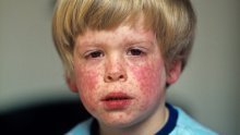 Necijepljenoj djeci u Dubrovniku zabranjen dolazak u vrtiće zbog epidemije ospica