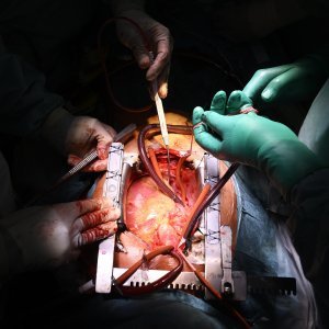 Transplantacija srca u Zagrebu