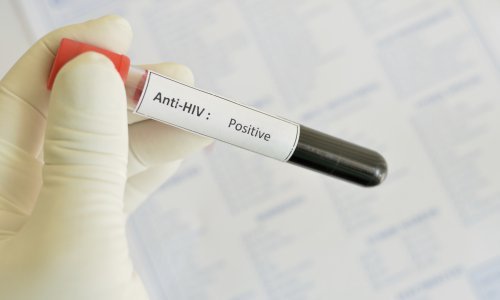 Broj oboljelih opada, prošle godine od AIDS-a preminulo milijun ljudi