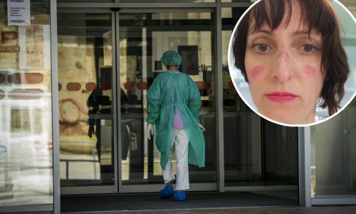 Potresna objava liječnice iz Čakovca: Jel vam ovo išta znači? Meni da. Ovo je moje lice nakon 4.5 h nošenja maske