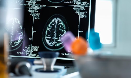 Zbunjenost, napadaji, udari: Kako koronavirus utječe na mozak?