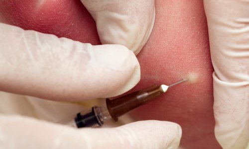 Kako je Jugoslavija pobijedila velike boginje: 'Nitko odluke liječnika nije dovodio u pitanje i svi su se htjeli cijepiti'