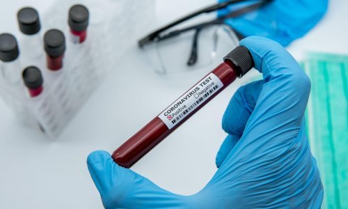 Serološki testovi krenuli su i kod nas: Otkrivamo čemu služe i što su zaključile zemlje koje su testiranje već obavile