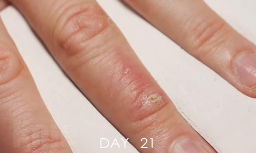 Pogledajte ubrzanu snimku zacjeljivanja rane