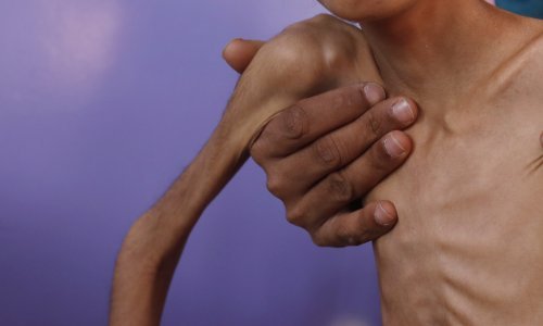 UN upozorio: Iskorjenjivanje gladi do 2030. je upitno; najviše gladnih u Aziji