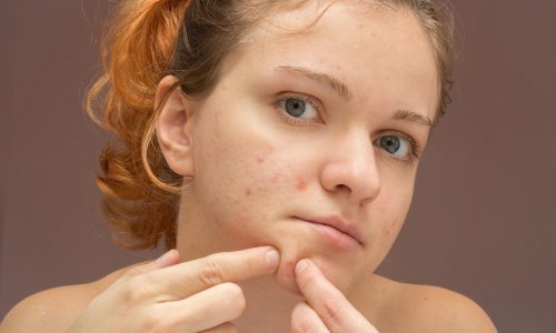 Ljeti nam je koža sklonija nastanku ožiljaka od akni, ali i za to ima lijeka