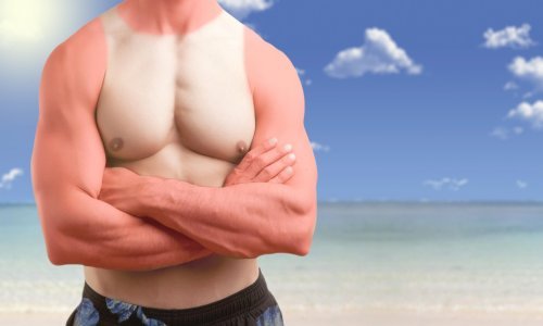 Ovaj tata duhovito je demonstrirao koliko je jako izgorio na Suncu