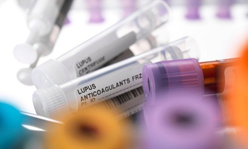 Kod pacijenata s teškim Covidom-19 imunološke stanice reagiraju kao kod lupusa