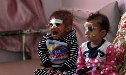 UN: U dijelovima Jemena dosad najveća pothranjenost djece, moguća smrt cijele generacije