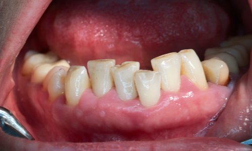 Upala desni povećava rizik od teških oboljenja Covida-19