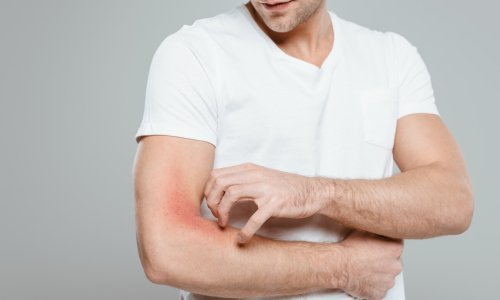 Struka se nada da će oboljelima od atopijskog dermatitisa postati dostupne nove biološke terapije