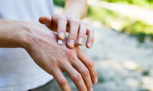 Psorijaza nosi rizik za srčano zatajenje, brojne druge bolesti, ali i sklonost suicidu