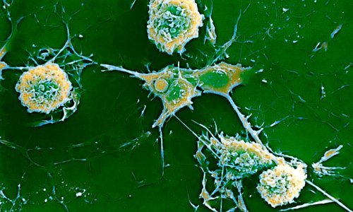 Mononukleoza vjerojatno jedan od uzročnika multiple skleroze