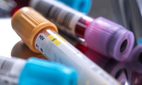 Prva žena izliječena od AIDS-a presađivanjem koštane srži