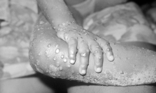 HZJZ se oglasio o majmunskim boginjama: 'Postoji mogućnost unosa u Hrvatsku'