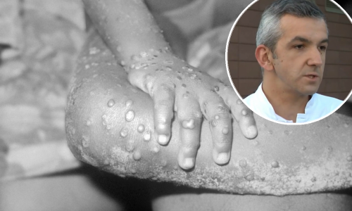 Kako se šire majmunske boginje i koji su simptomi? Evo što kaže liječnik