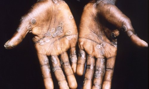 U Europi nije zabilježen smrtni slučaj od majmunskih boginja