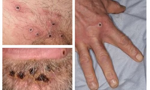 WHO proglasio najviše upozorenje zbog majmunskih boginja