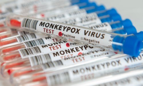 U svijetu više od 18.000 slučajeva majmunskih boginja, većina u Europi