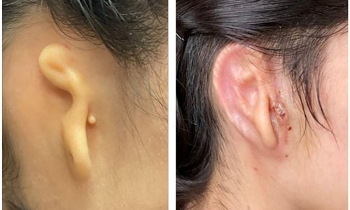 Revolucija u rekonstrukcijskoj kirurgiji: Od stanice pacijenta 'isprintano' uho u 3D printeru